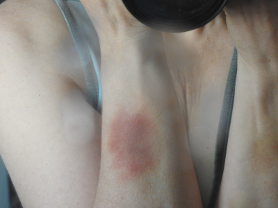 warwounds.png